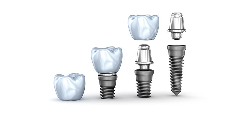 screw-retained-implant-crown